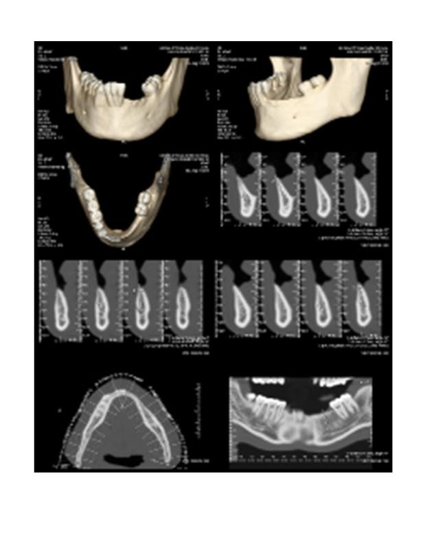 Denta scan (Figure 2) was done to evaluate the bone quality and quantity.