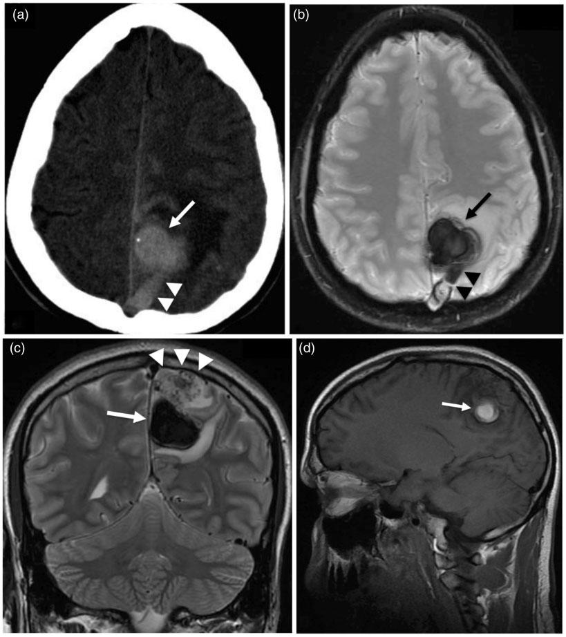 Cao et al. 223 16, Siemens, Erlangen, Germany) then a brain magnetic resonance imaging (MRI) (3 T; Signa HDX, GE, Milwaukee, USA) in emergency conditions.