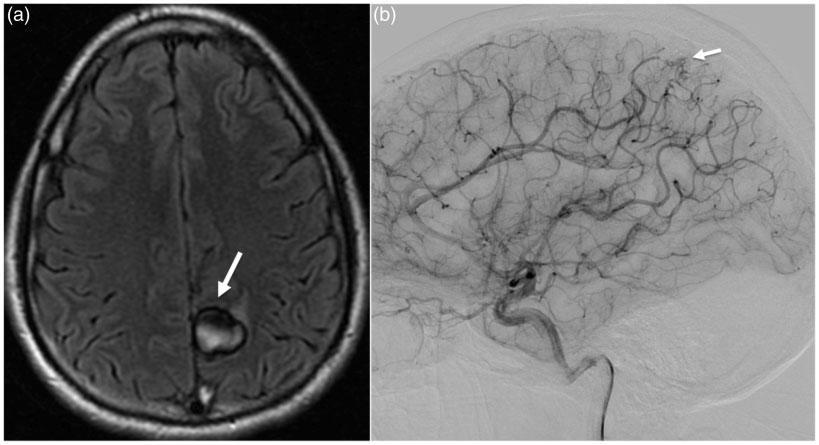 Cao et al. 225 Figure 4. (a) Brain magnetic resonance imaging (MRI) (3 T) performed at three months.