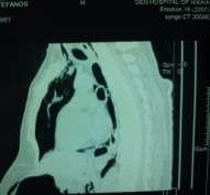 Images 1-4 Dilatation of the large bowel, pneumoperitoneum, pneumomediastinum, pneumopericardium and subcutaneous
