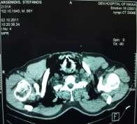 colon, gross spillage of an excessive amount of feces in the peritoneal cavity and the right retroperitoneal space