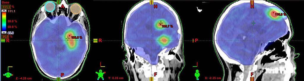 RA for WBRT and boost to multiple metastases d F. J. LAGERWAARD et al. 257 Fig. 3. Composite RapidArc plan with whole-brain radiotherapy and integrated boost to multiple metastases for patient C.