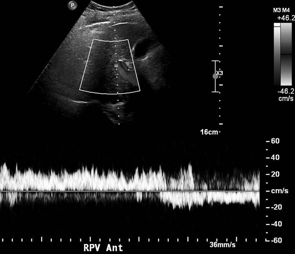 Management of Recurrent Hepatic Encephalopathy Figure 1. Ultrasound Doppler with spectral analysis demonstrates loss of expected retrograde flow in the right portal vein.