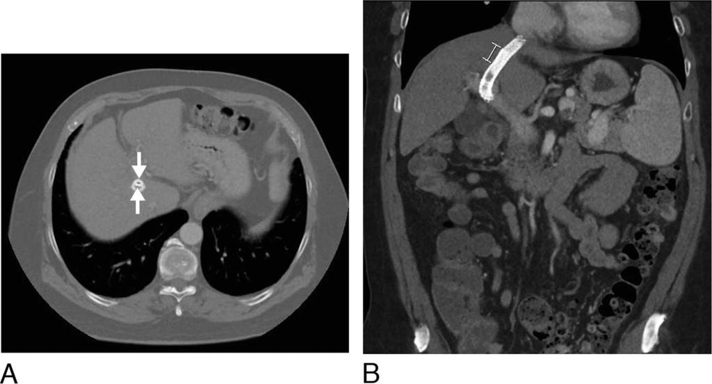 Khalili, H Figure 5. A. Axial computed tomography (CT) image of the liver shows the deployed Genesis stent (top arrow) and the reduced patent lumen of the new VIATORR stent (bottom arrow). B.