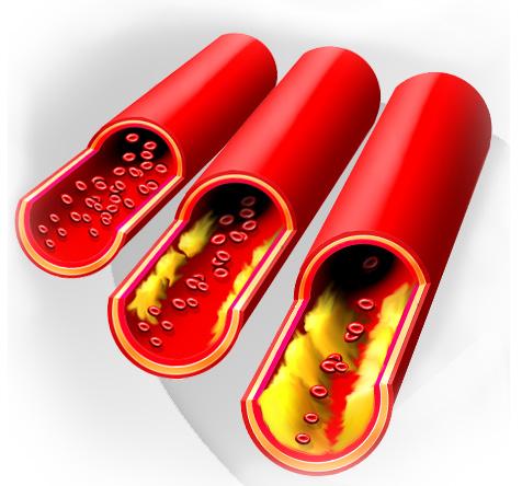 As cholesterol builds up inside the arteries, less blood can pass through! Heart Activity 2 What is this cholesterol, anyway? What is cholesterol, again?