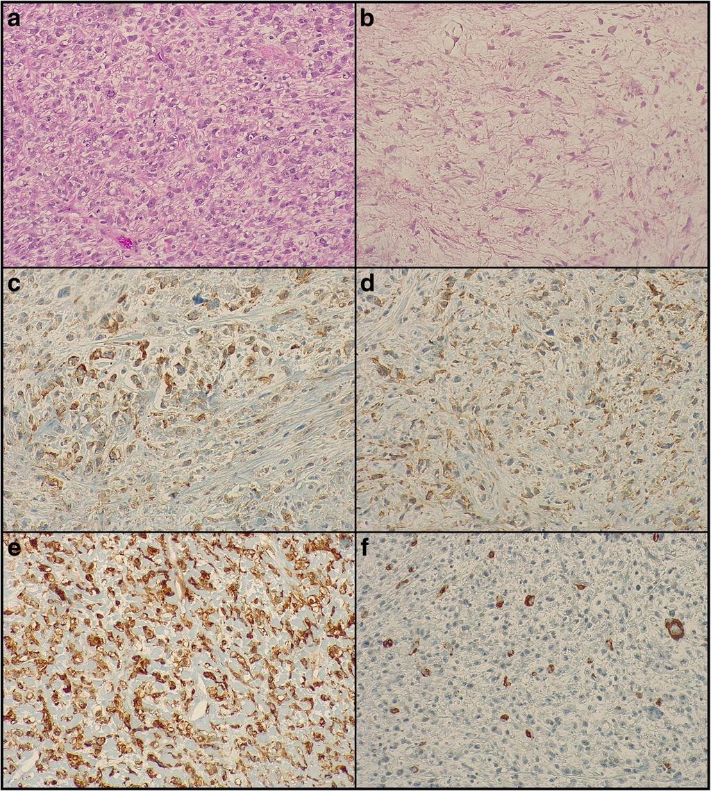 Mollo et al. BMC Women's Health (2018) 18:169 Page 4 of 5 Fig. 3 Histological features of the sarcoma (magnification 200x).