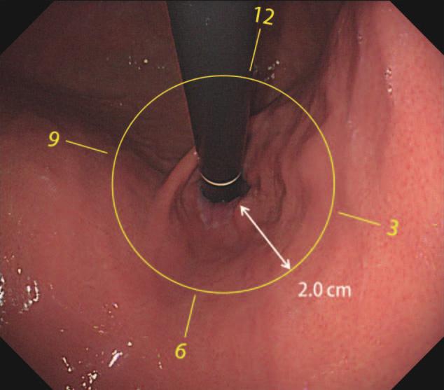 Jang et al Medicine Volume 94, Number 31, August 2015 the Paris endoscopic classification, 14 and a biopsy before the procedure interpreted as adenoma (low and high grade dysplasia) or adenocarcinoma.