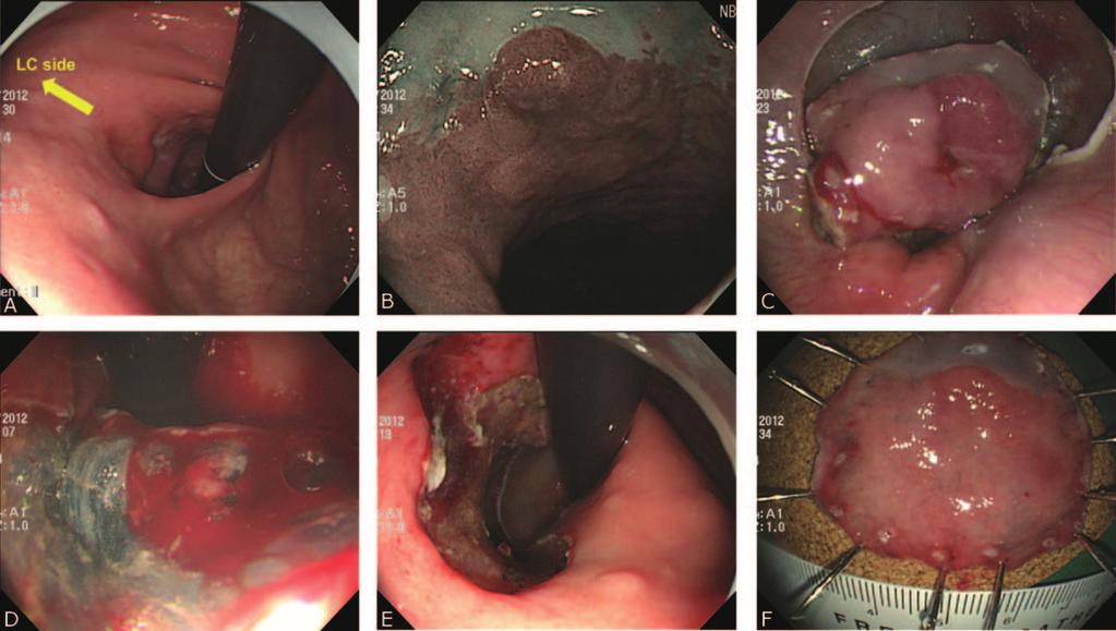 Medicine Volume 94, Number 31, August 2015 ESD of Gastric Cardia Tumors FIGURE 2. Example of endoscopic submucosal dissection for a gastric cardia tumor with esophageal extension.