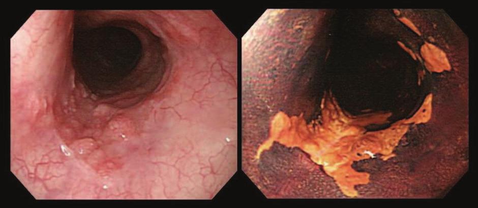 94 Gastrointestinal Endoscopy Fig. 4. 0-IIa+IIc lesion was seen in middle esophagus. EMR was performed Mod.SCC,pSM1, ly3, v0, INFc CRT(ND+5FU, 66Gy) Fig. 5.