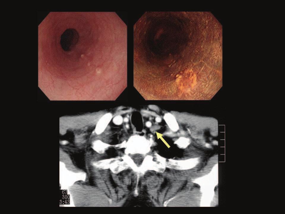 Combination Therapy After EMR/ESD for Esophageal Squamous Cell Carcinoma with Submucosal Invasion 95 Fig. 6. After 6 month later, intrmural metastasia and cervical lymph node were detected.