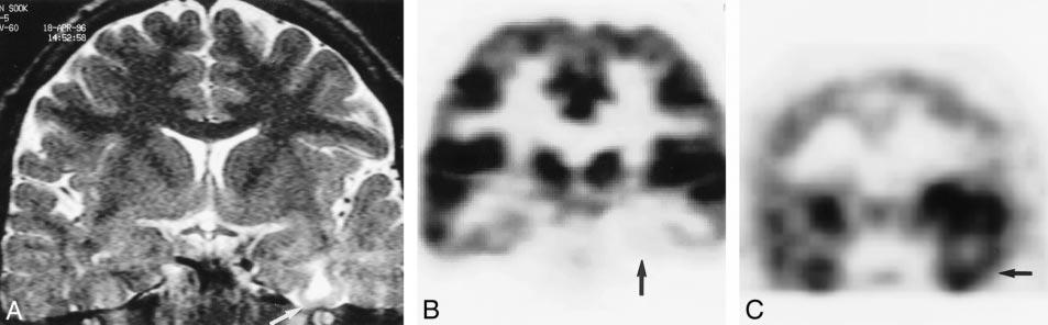 AJNR: 22, May 2001 NEOCORTICAL EPILEPSY 941 FIG 1. Concordance of the results among MR imaging, PET, and ictal SPECT findings for a 36-year-old man with left neocortical temporal lobe epilepsy.