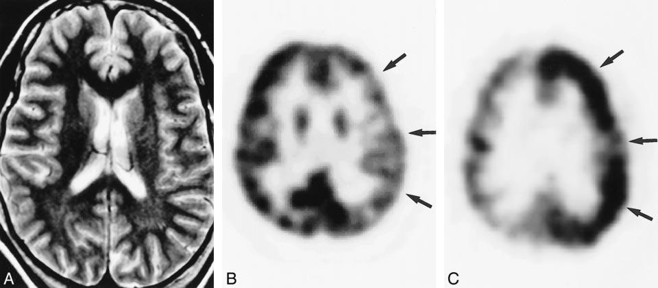 B, FDG PET scan shows hypometabolism in the left inferior temporal lobe (arrow). C, Ictal SPECT scan shows focal hyperperfusion in the left inferior temporal lobe (arrow).