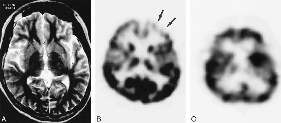 942 HWANG AJNR: 22, May 2001 FIG 3. False-negative MR imaging and ictal SPECT findings for an 18-year-old female patient with left frontal lobe epilepsy.