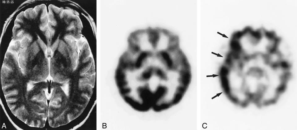 C, Ictal SPECT scan fails to show hyperperfusion in any area. Lesion-like increased uptake in the left basal ganglia is due to asymmetrical reconstruction of the image.