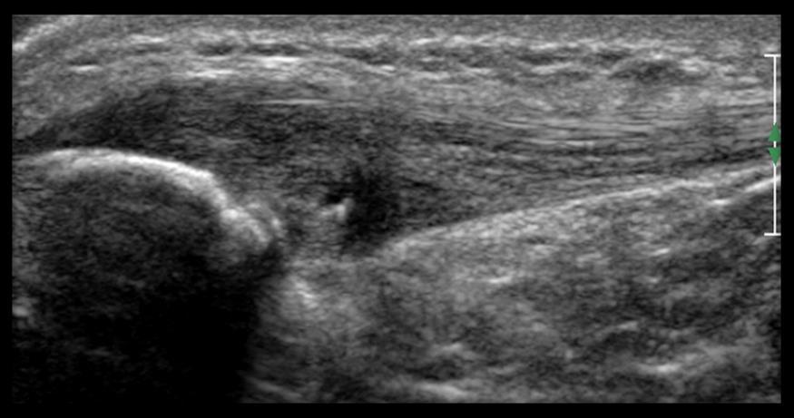Partial tendon tear Focal defect well defined not anisotropy