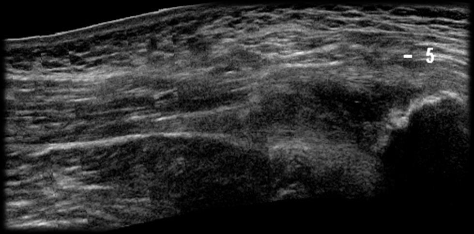 intrasubstance Background tendinosis tendon usually thick may be