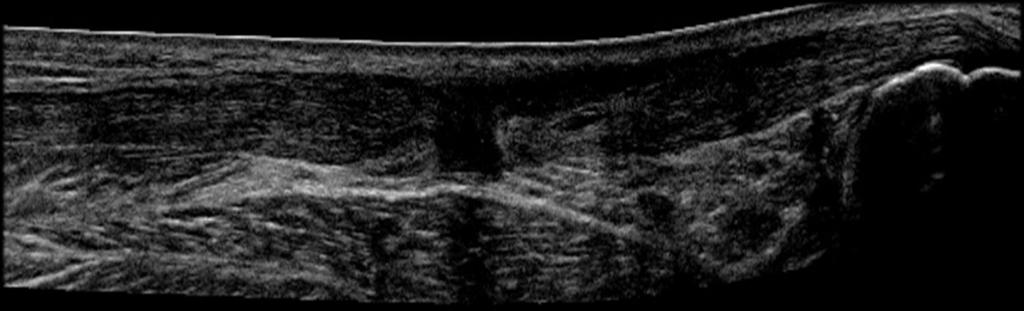 Full thickness tendon tear From articular bursal surface Focal incomplete, entire width complete Gap vs absence control for anisotropy