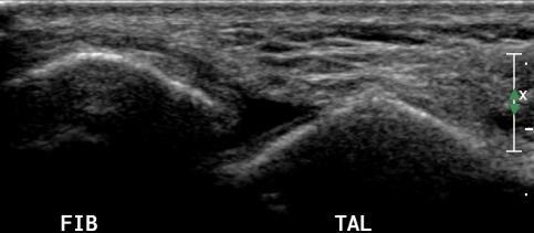 Ankle inversion ATFL evaluation appearance of ligaments similar to tendon retracted edges