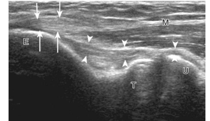 Elbow: ulnar collateral ligament (UCL) Hyperechoic compact fibers Medial epicondyle