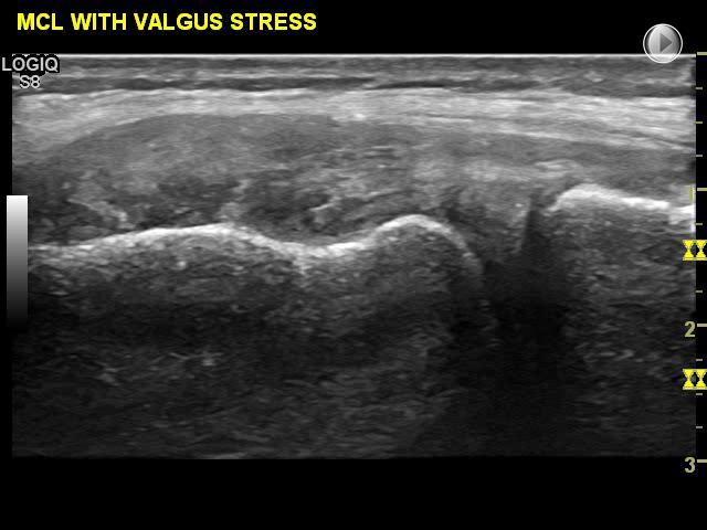 valgus stress test can be