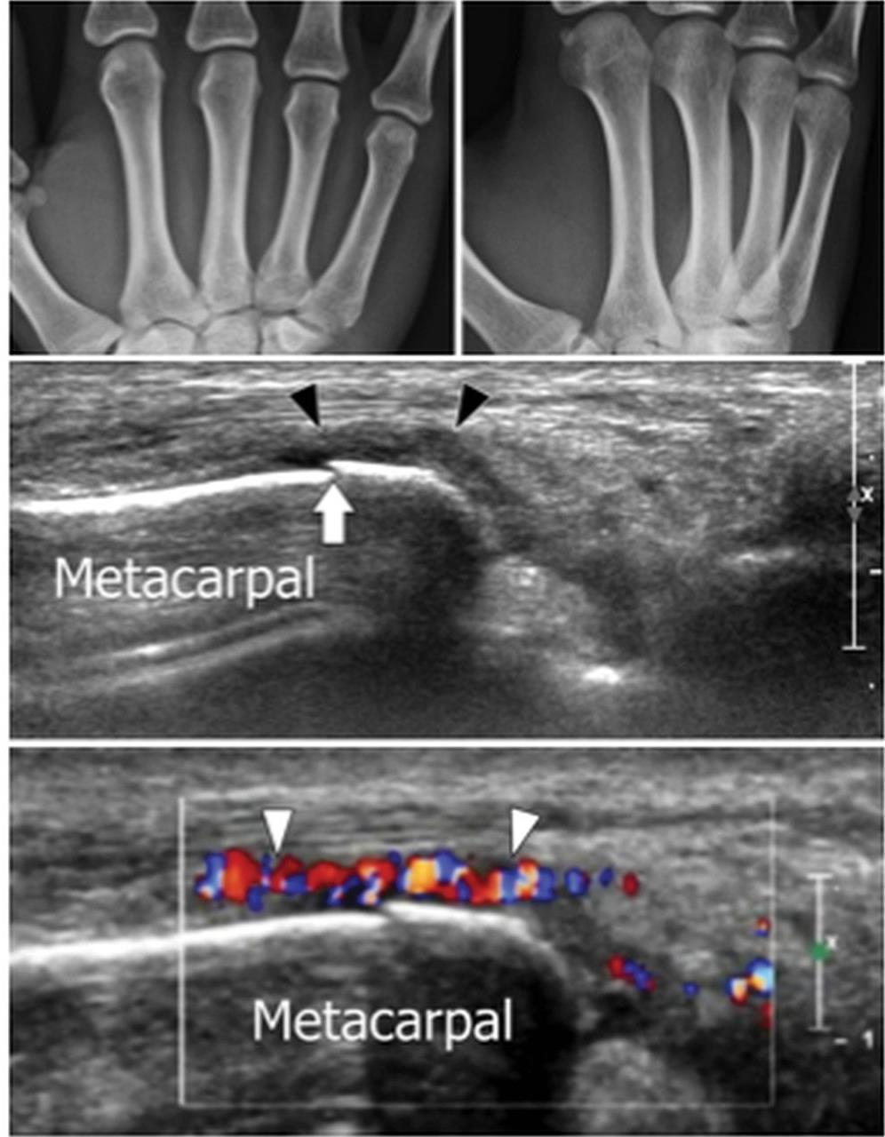 4 th metacarpal fx Fourth metacarpal fracture. (A) (A) Normal radiographs in a patient with post-traumatic pain at the fourth metacarpal phalangeal joint.