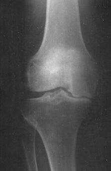 This preoperative radiograph (x-ray) shows severe loss of cartilage affecting the