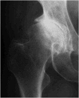 Plain radiograph of the right hip joint demonstrates marked joint space narrowing,
