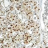 100 % Breast carcinoma, ductal (n = 178) 0 % Breast carcinoma, lobular (n = 65) 0 % PAX-8 as a marker for kidney cell carcinomas and their metastases Besides its value as an ovarian carcinoma marker,