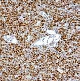 Expression of PAX8 as a useful marker in distinguishing ovarian carcinomas from mammary carcinomas. Am J Surg Pathol 32:1566-1571, 2008 [4] Tacha D et al.