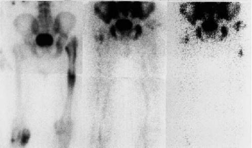 BONE and WHITE BLOOD CELL SCINTIGRAPHY IN INFECTED HIP PROSTHESIS