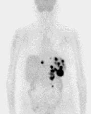 FDG PET(-CT) IMAGING IN FUO 76-year-old female Fever and weight loss Blood,urine, broncho-alveolar lavage fluid and bone marrow cultures were negative.