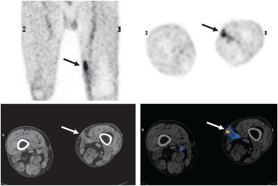 Wasselius et al, J Nucl Med 2008;49:1601-1605 FDG PET(-CT) IMAGING IN ENDOVASCULAR GRAFT INFECTION FIGURE 2. A 68-y-old man who had received left femoropopliteal bypass graft 18 mo previously.