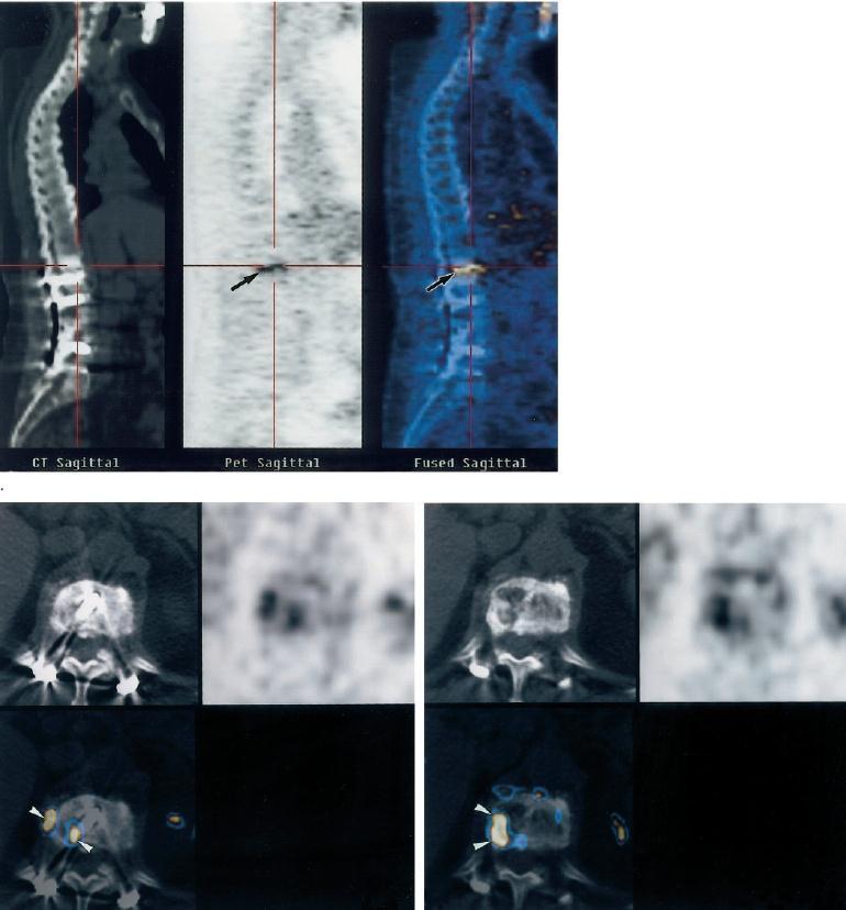 75-year old woman 2 years after lumbar decompression and spondylodesis of the lumbar spine, who was suspected of having a low-grade