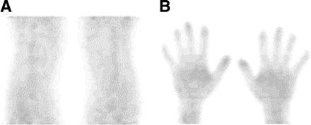 FDG PET(-CT) IMAGING IN REUMATOID ARTHRITIS 18F-FDG PET images of healthy control subject (A and B) RA patient with active disease (C and D) 18F-FDG