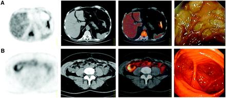 FDG PET(-CT) IMAGING IN INFLAMMATORY BOWEL DISEASE FIGURE 1. From left to right, examples of PET, CT, PET/CT, and corresponding endoscopic appearance.