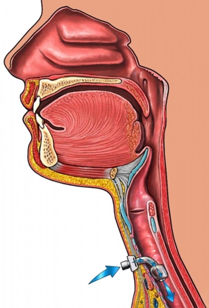 Speaking valve The essential principles of tracheostomy