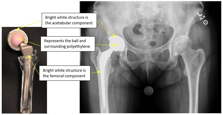 What Are Hip and Knee Replacement Implants Made Of?