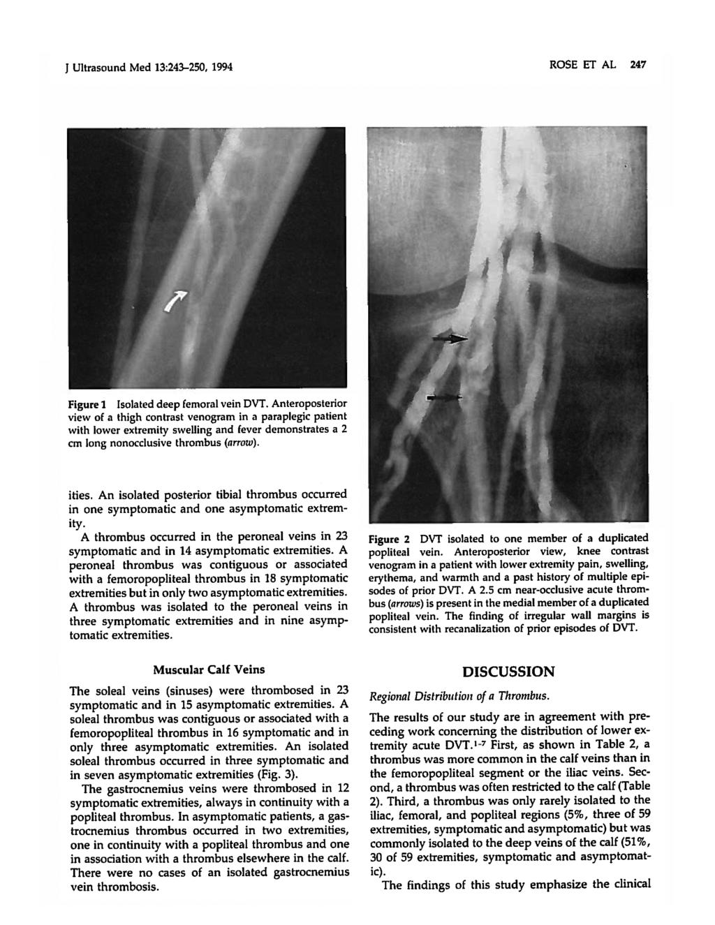 J Ultrasound Med 13:24~250, ROSE ET AL 1994 247 Figure 1 deep femoral vein DVT.