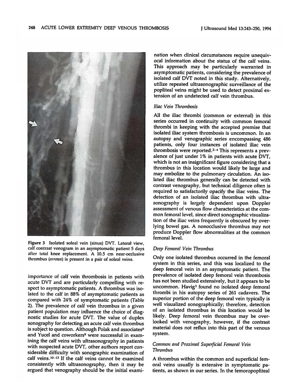 248 ACUTE LOWER EXTREMITY DEEP VENOUS THROMBOSIS J Ultrasound Med 13:243-250, 1994 nation when clinical circumstances require unequivocal information about the status of the calf veins.