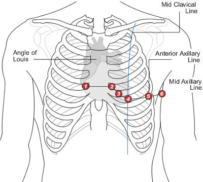 Positions of Chest Leads V1 - Fourth intercostal space at the right sternal border. V2 - Fourth intercostal space at the left sternal border. V3 - Midway between placement of V2 and V4.