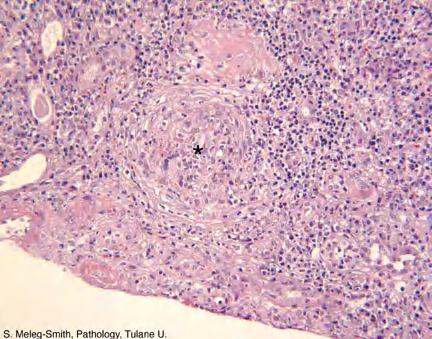 Crescentic Glomerulonephritis (RPGN) Background Rapidly progressive glomerulonephritis (RPGN) is defined as any glomerular disease characterized by extensive crescents (usually >50%) as the principal