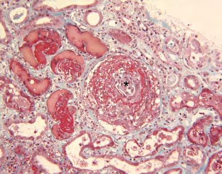 Glomerulonephritis, crescentic. Light microscopy (200x periodic acid-schiff stain): Bowman capsule (arrow) surrounds each glomerulus.