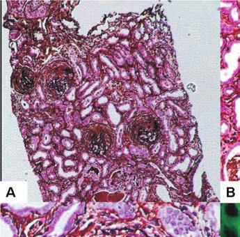Dual positive serology in a case of rapidly progressive glomerulonephritis in a middle aged woman Figure 1 A.