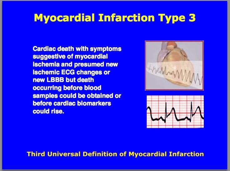 Myocardial Infarction Type 2 I21.A Other type of myocardial infarction I21.