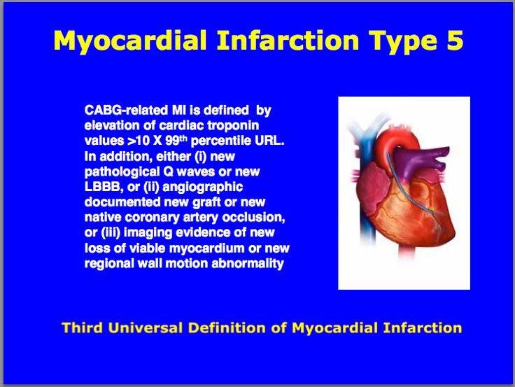 Myocardial Infarction Type 5 All Rights Reserved 29 Myocardial Infarction Type 3, 4a, 4b, 4c, 5 I21.