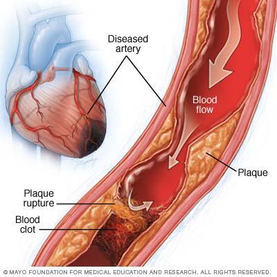 Myocardial Ischemia Myocardial ischemia occurs when blood flow to the heart muscle (myocardium) is obstructed by a partial or complete blockage of a coronary artery by a buildup of plaques