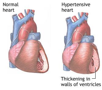 Hypertensive Heart Disease I10 I15 Hypertensive diseases All Rights Reserved 9 Hypertension Hypertension, also referred to as high blood pressure, is a condition in which the arteries have