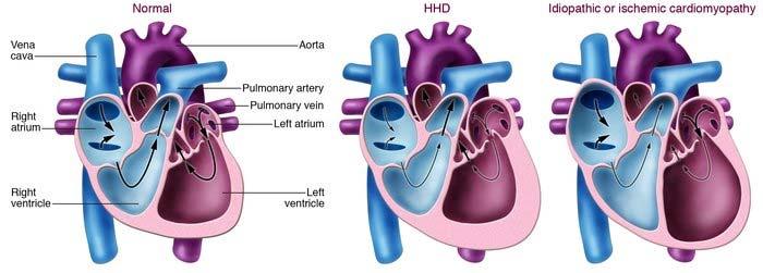 Hypertension I13 Hypertensive heart and chronic kidney disease: stage of and type of heart failure must be identified.