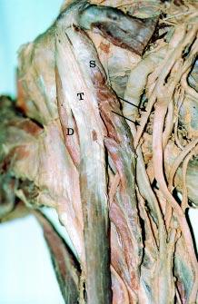 Folia Morphol., 2001, Vol. 60, No. 3 posed axillary vessels specifically in postmastectomy reconstructive operations [7].