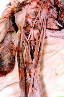 Folia Morphol., 2001, Vol. 60, No. 3 Figure 5. A photograph of the right arm of an adult human cadaver showing superficial head (S) and deep head (D).